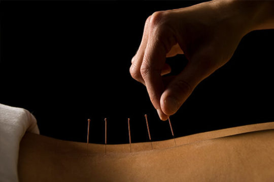 Acupuncture in Solana Beach, CA